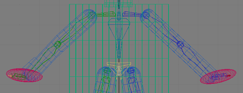 Рис. 25. Вид верхних конечностей после полной корректировки их длины и положения